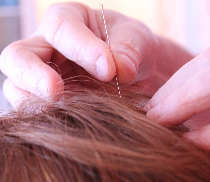 Acupuncture Needle In Scalp