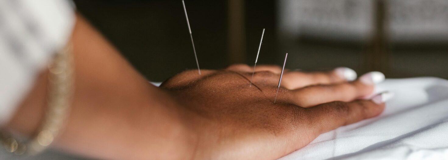 Acupuncture For Anxiety And Pmt